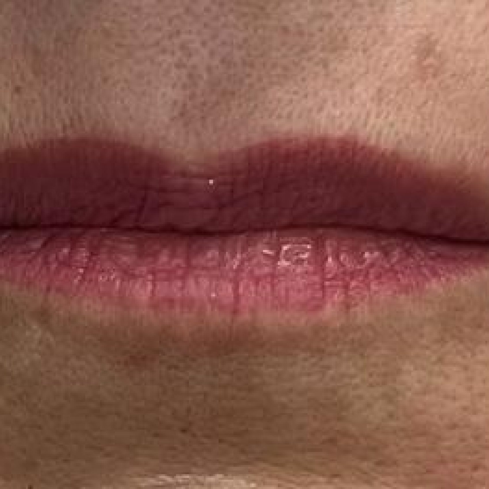 Preenchimento Labial (antes)