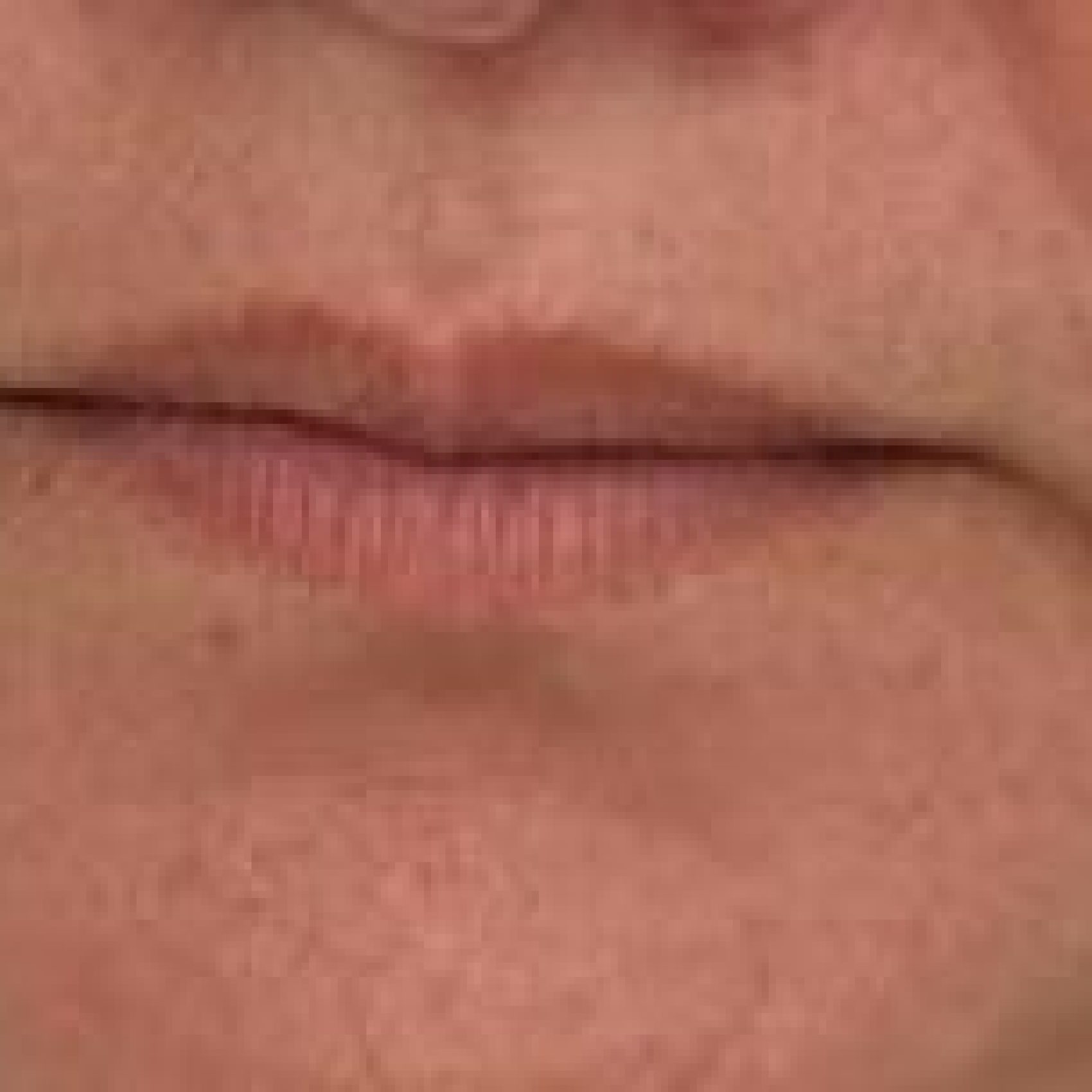 Preenchimento Labial (antes)