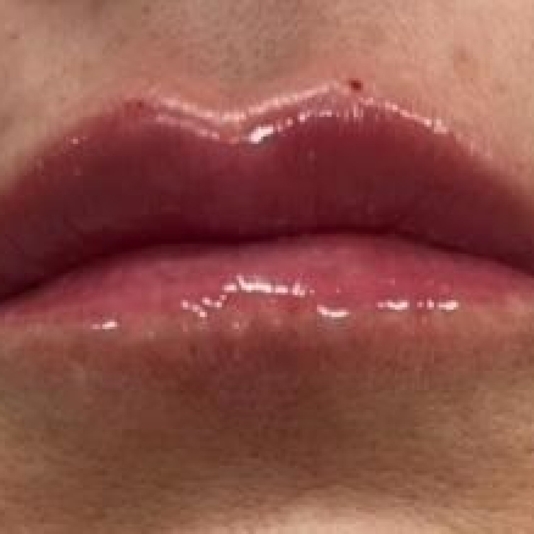 Preenchimento Labial (depois)