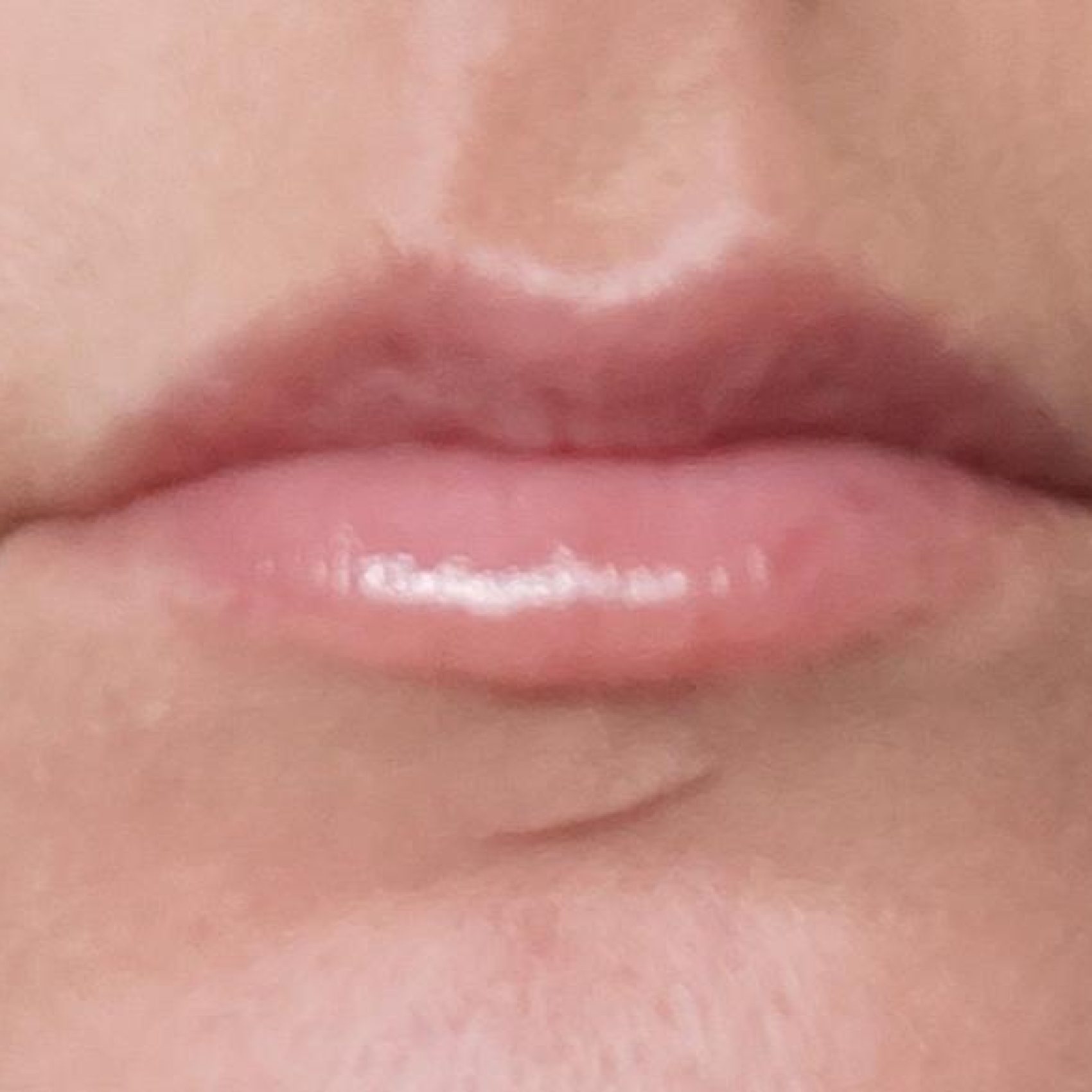 Preenchimento Labial (depois)