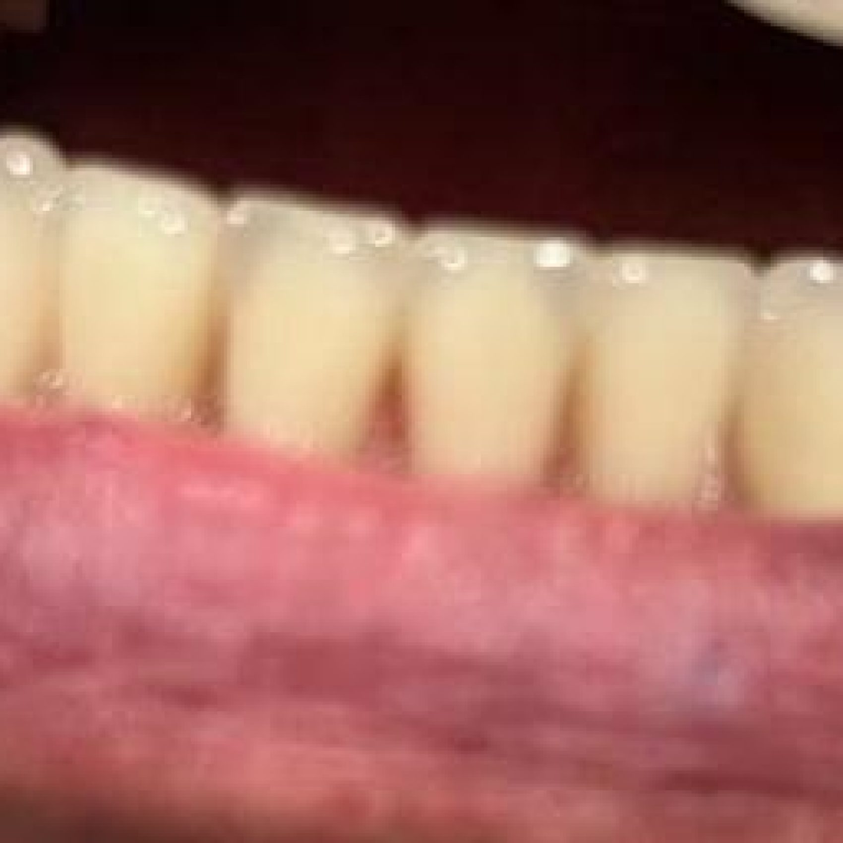 Protocolo Inferior (sobre implantes) em Resina